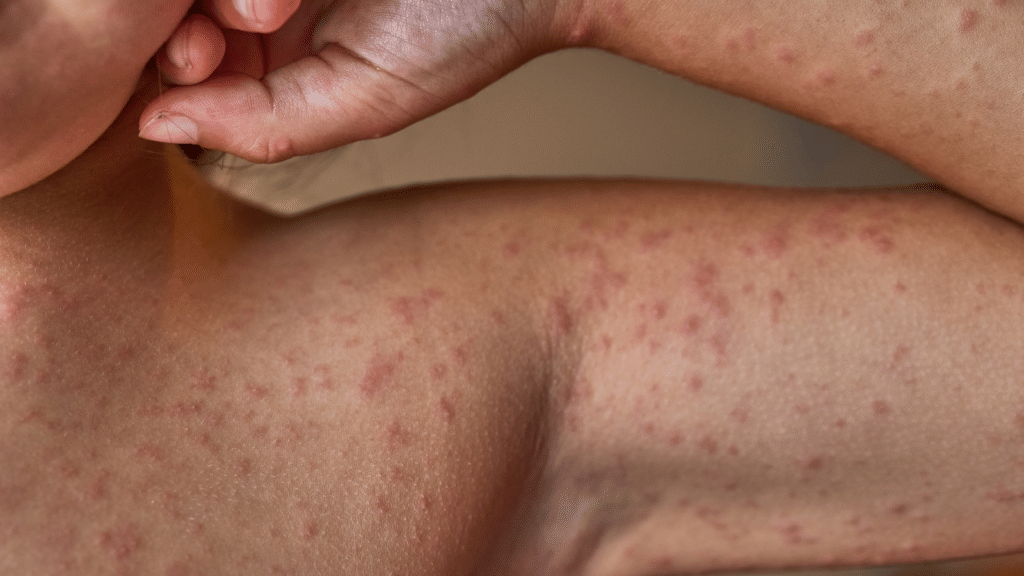 Allergic Reaction Due To Antibiotics